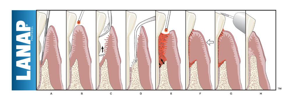 Laser Periodontal Therapy  in Temple City
