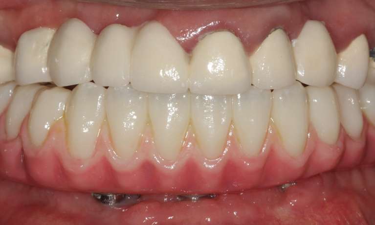 Dental-Implants-After-Image