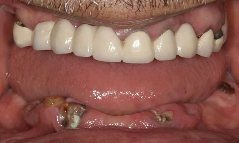 Dental-Implants-Before-Image